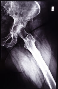 $250,000 Settlement for Atlanta Man Who Broke Hip In Car Accident