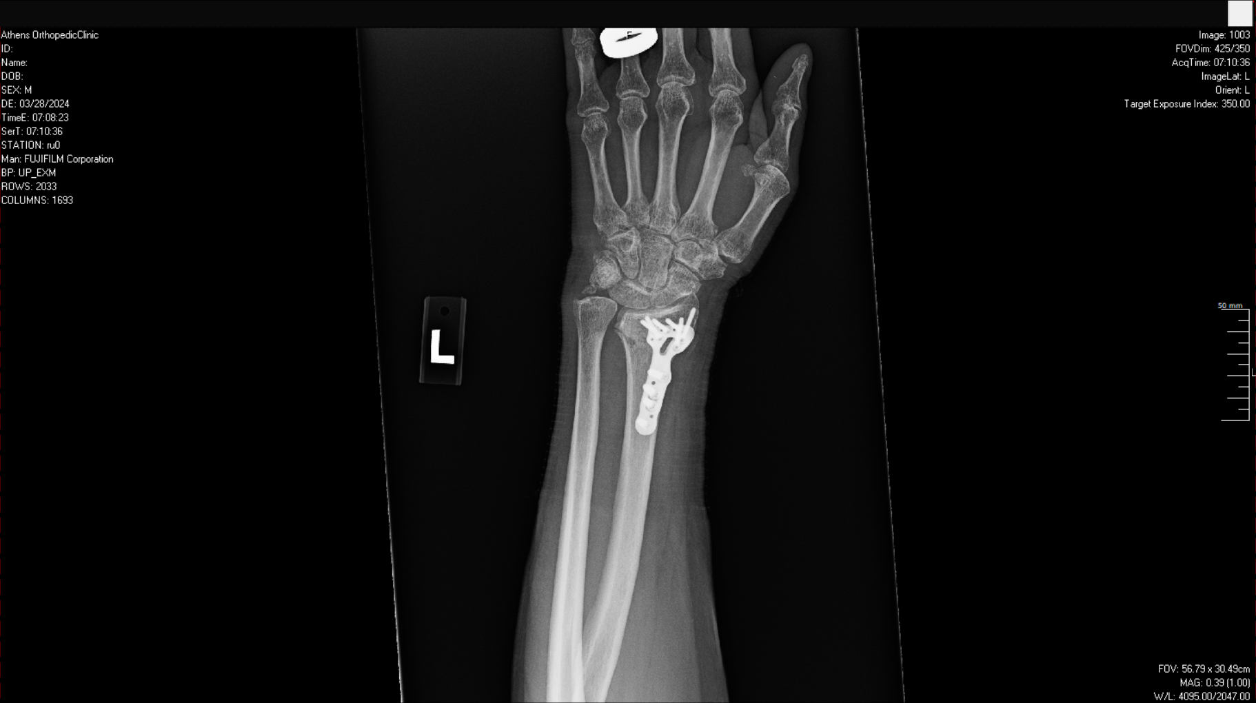 $200,000 Settlement for Broken Wrist in Georgia Car Accident - Ruppersburg