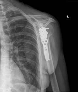 shoulder surgery settlement